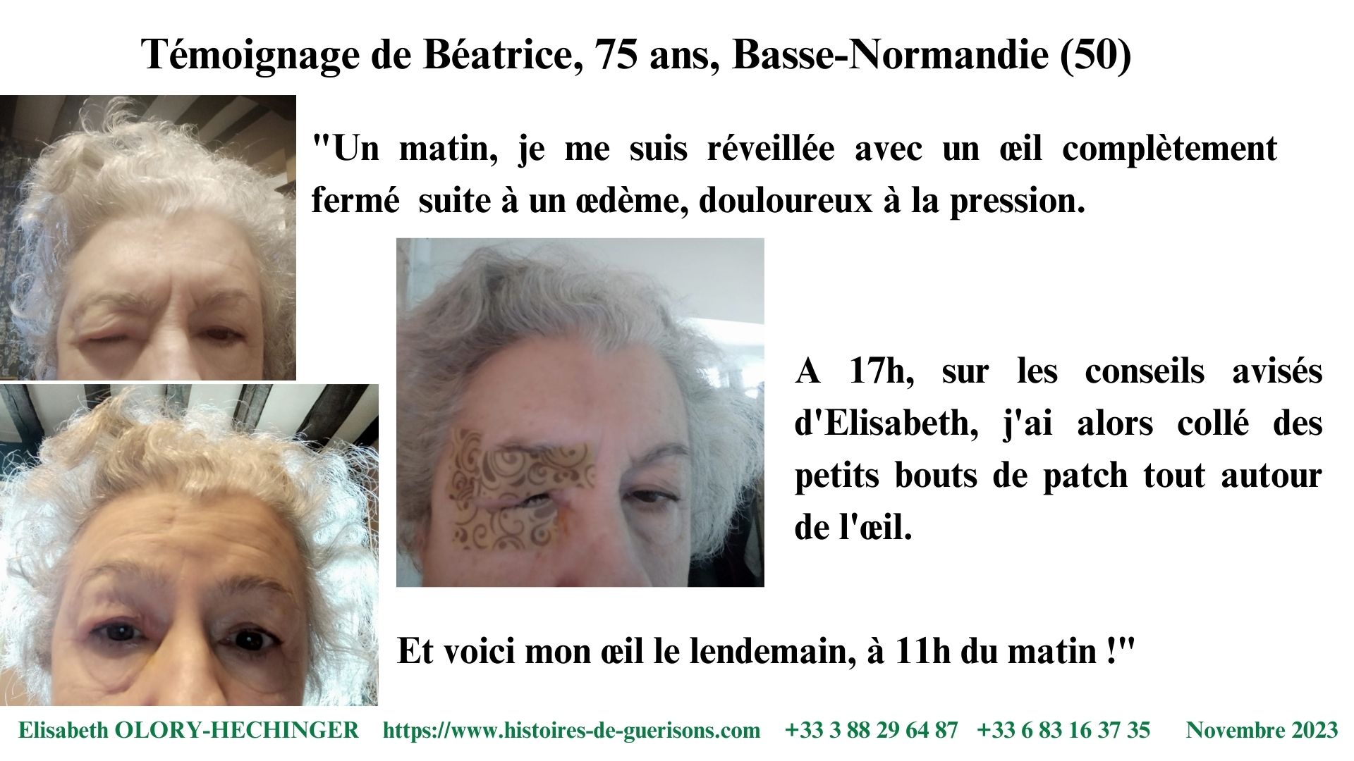 Béatrice œdème à l'œil